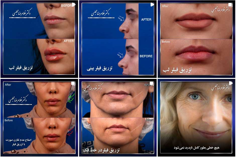 دکتر مجلسی اصفهان تزریق ژل
