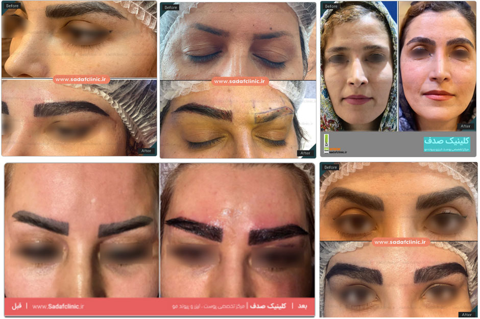 نمونه کار کاشت ابرو در کلینیک صدف
