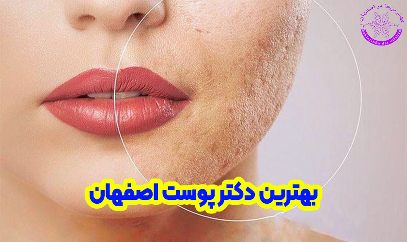 بهترین دکتر پوست اصفهان
