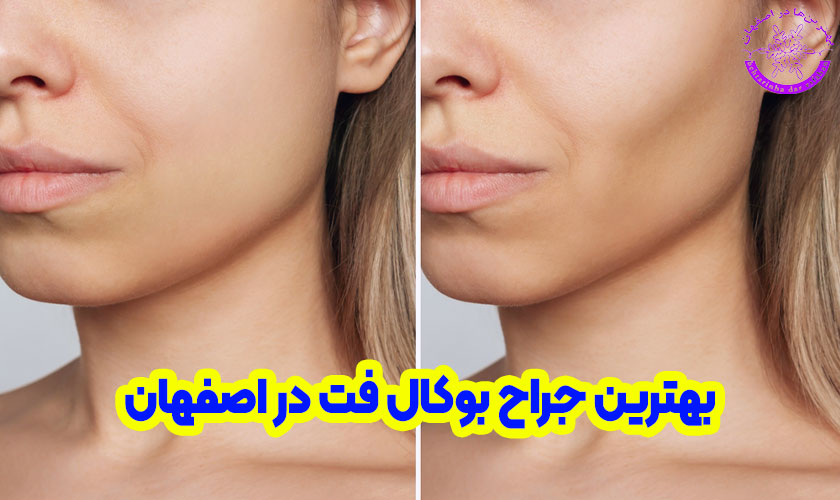 بهترین جراح بوکال فت در اصفهان