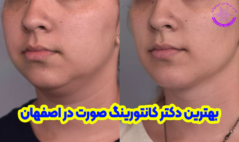 بهترین دکتر کانتورینگ صورت در اصفهان