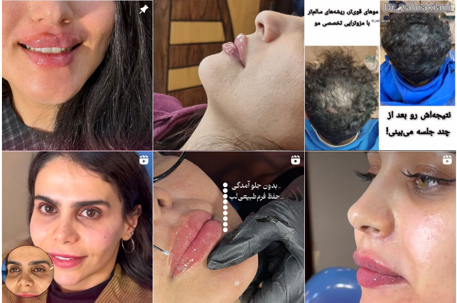 نمونه کار تزریق ژل لب در اصفهان
