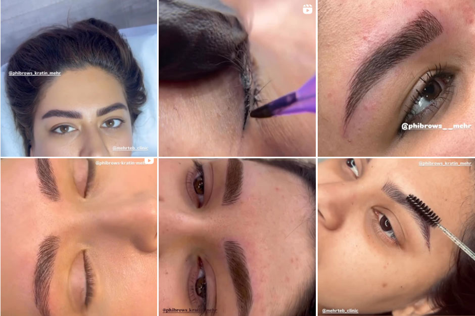 بهترین مرکز فیبروز ابرو در اصفهان