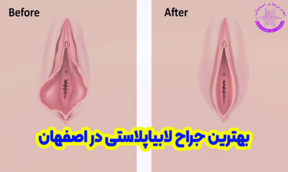 بهترین جراح لابیاپلاستی در اصفهان