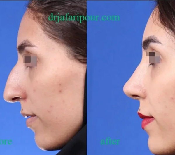 نمونه کار دکتر مسعود جعفری پور اصفهان