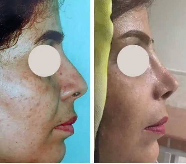 نمونه کار دکتر علیپور جراح بینی اصفهان