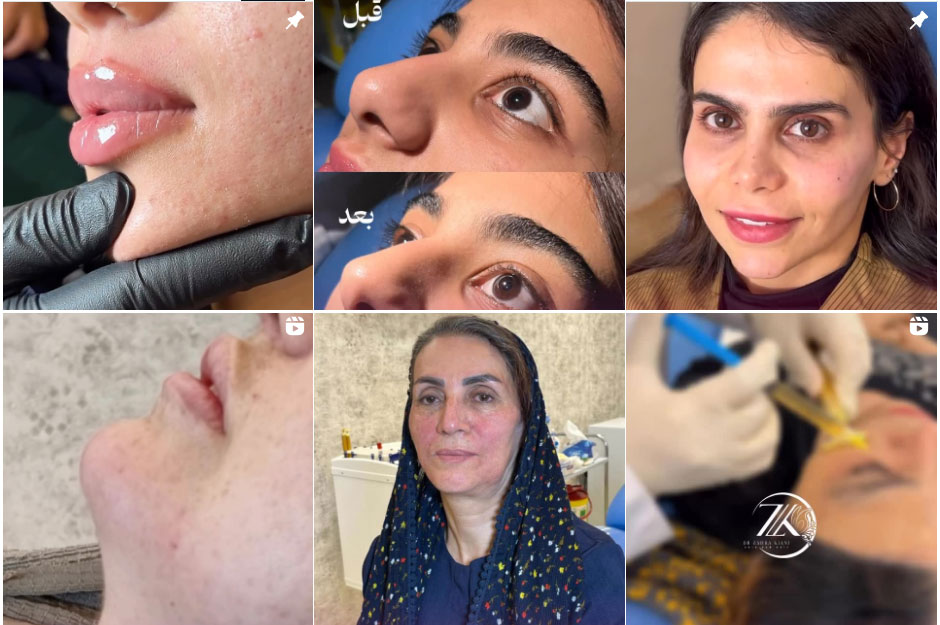 نمونه کارهای بوتاکس زهرا کیانی