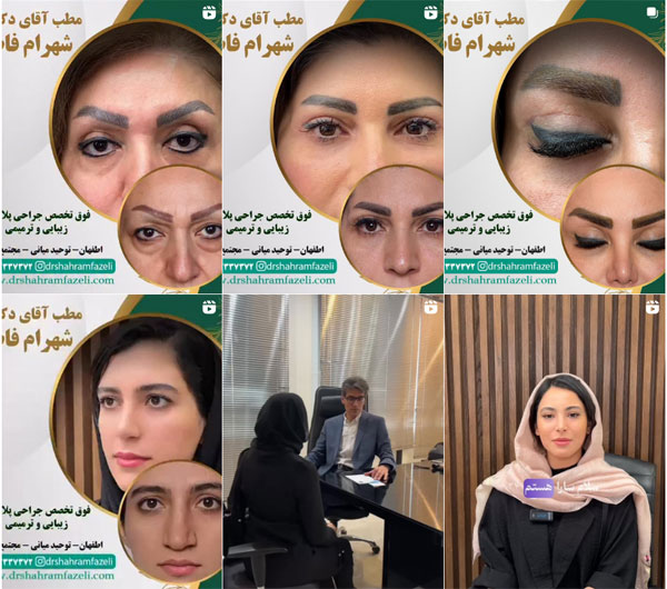 دکتر خوب برای عمل بلفاروپلاستی در اصفهان