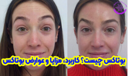 بوتاکس چیست