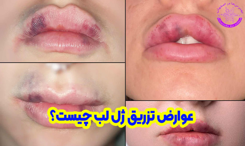 عوارض تزریق ژل لب چیست