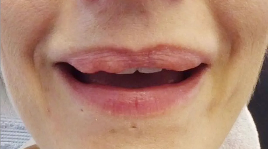 گلوله شدن ژل و تشکیل گره در لب