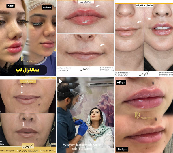 نمونه کار جراحی سانترال لب دکتر رامین مدرسی