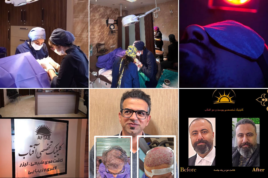 کاشت مو اقساطی اصفهان