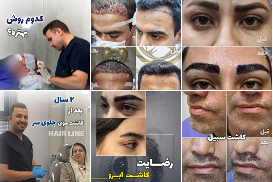 نمونه کار کاشت مو کلینیک بنیتا